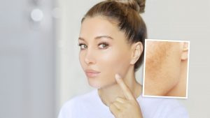 Cómo despigmentar las manchas provocadas por el sol