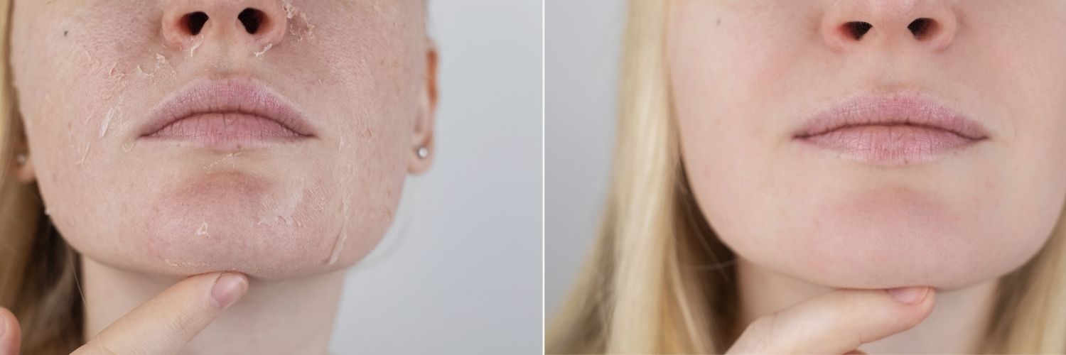 Peeling con ácido ferúlico: recupera tu piel del verano